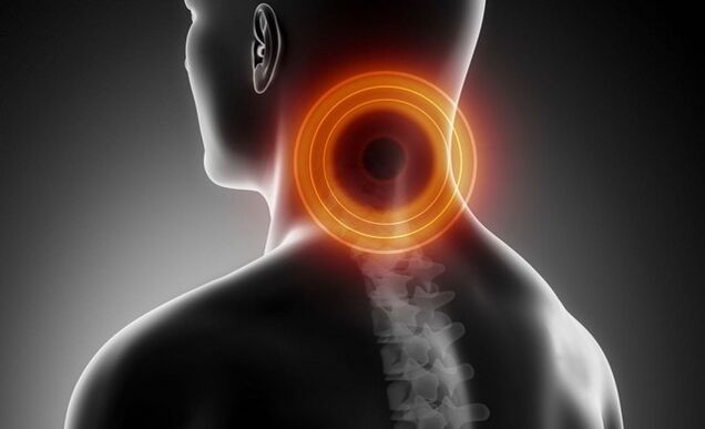 cervikalgija s cervikalnom osteohondrozom